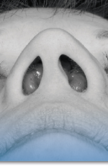 Reconstrucción Nasal y Cierre de Perforación Septal
